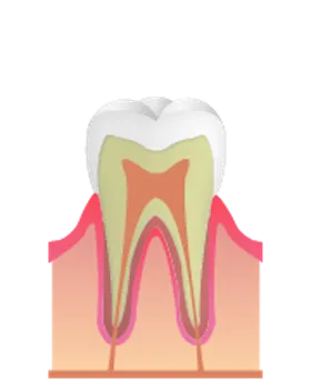 Co（初期う触）