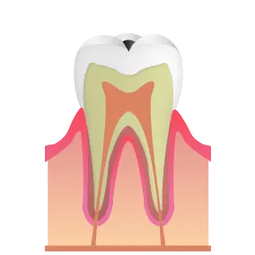 C1（エナメル質う触）