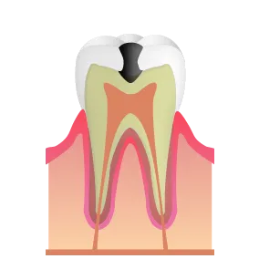 C2（象牙質う触）