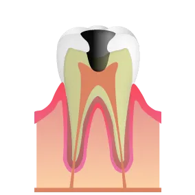 C3（神経まで達したう触）
