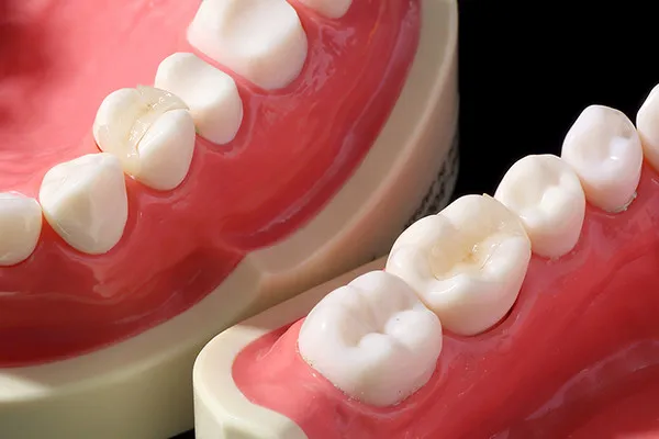 セラミックインレー（e.maxセラミック）